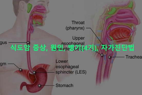 식도암 증상, 원인, 병기(4기), 자가진단법