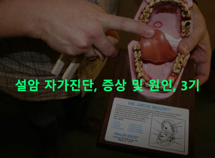 설암 자가진단, 증상 및 원인, 3기