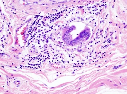 담낭암 병기 (1기, 2기, 3기, 4기)