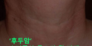 후두암 초기증상 목소리 및 가래, 자가진단과 원인