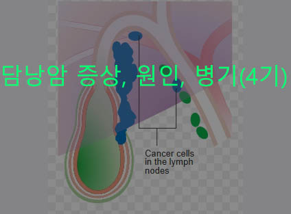 담낭암 증상, 원인, 병기(4기)