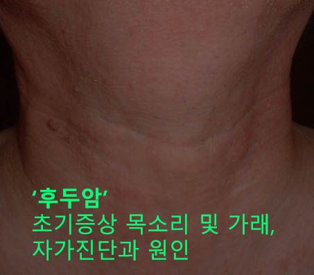 후두암 초기증상 목소리 및 가래, 자가진단과 원인