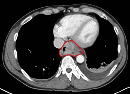 식도암 진단방법