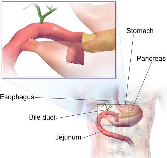 식도암의 예방법