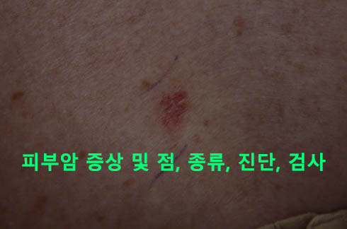 피부암 증상 및 점, 종류, 진단, 검사