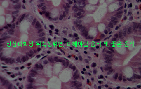 장상피화생 위축성위염, 피해야할 음식 및 좋은 음식