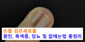 손톱 검은세로줄 원인, 흑색종, 당뇨 및 없애는법 총정리