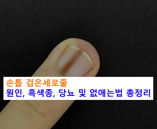 손톱 검은세로줄 원인, 흑색종, 당뇨 및 없애는법 총정리