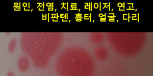선상태선 원인, 전염, 치료, 레이저, 연고, 비판텐, 흉터, 얼굴, 다리