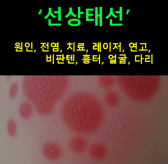선상태선 원인, 전염, 치료, 레이저, 연고, 비판텐, 흉터, 얼굴, 다리